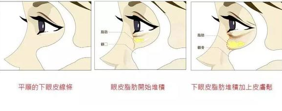 去眼袋手术
