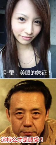 去眼袋手术