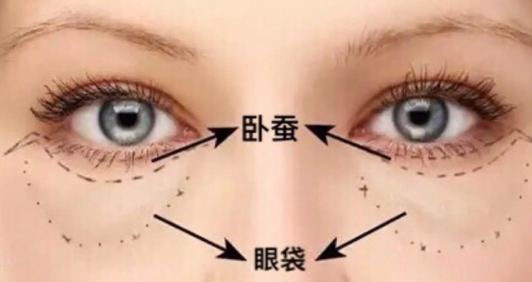 去眼袋手术