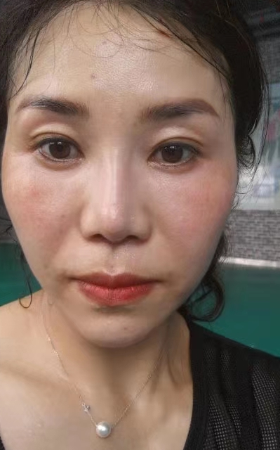 去眼袋手术