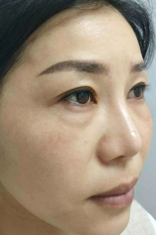 去眼袋手术