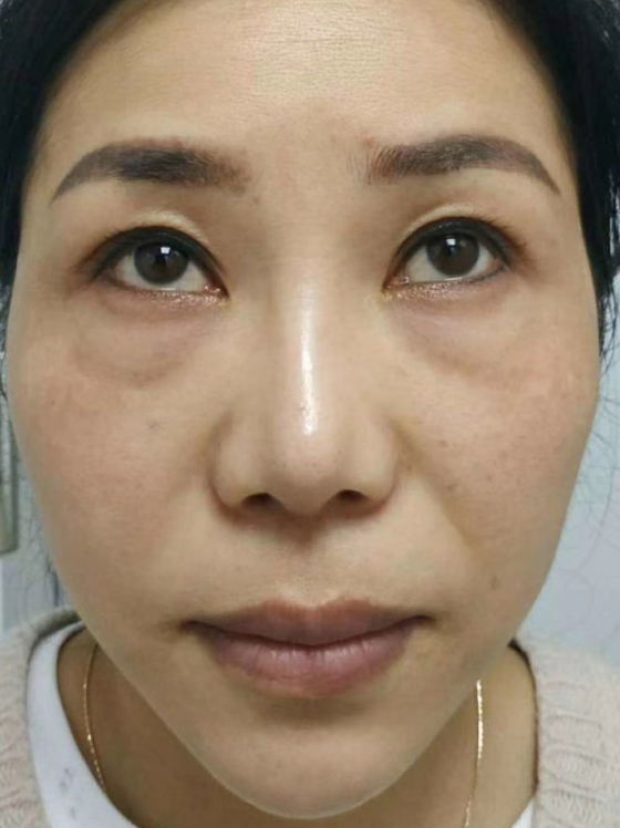 去眼袋手术