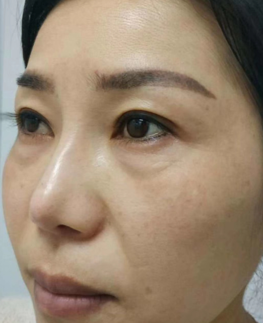去眼袋手术