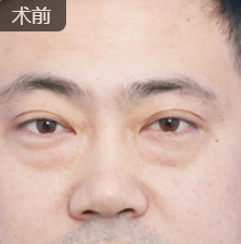 男士去眼袋哪里去？超雅不开刀按摩去眼袋！_1452