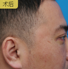 男士去眼袋哪里去？超雅不开刀按摩去眼袋！_1452