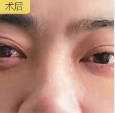 男士去眼袋哪里去？超雅不开刀按摩去眼袋！_1452