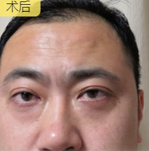 男士去眼袋哪里去？超雅不开刀按摩去眼袋！_1452