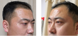 男士去眼袋哪里去？超雅不开刀按摩去眼袋！_1452