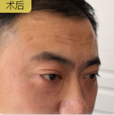男士去眼袋哪里去？超雅不开刀按摩去眼袋！_1452