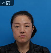 去眼袋手术