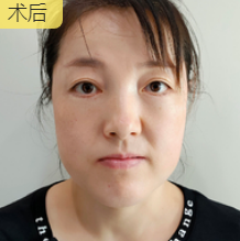 去眼袋手术