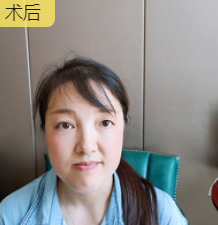 去眼袋手术