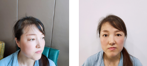 去眼袋手术