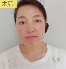 去眼袋手术