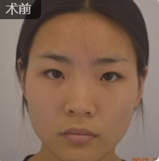 去眼袋手术