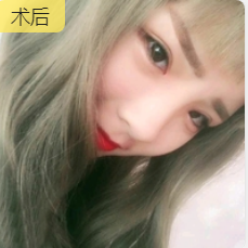 去眼袋手术