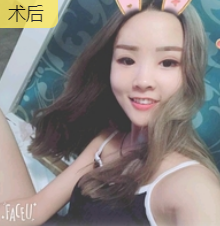 去眼袋手术