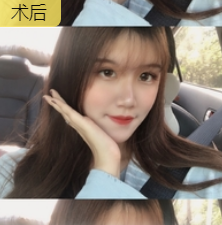 去眼袋手术