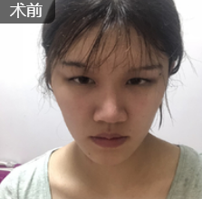 去眼袋手术