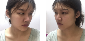 去眼袋手术