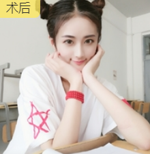 去眼袋手术