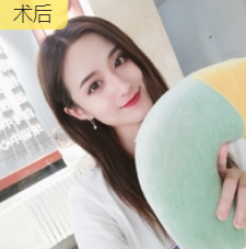 去眼袋手术