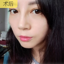 眼袋消除是不介入治疗?超雅的不开刀按摩去眼637 眼袋消除是不介入治疗?超雅的不开刀按摩去眼637
