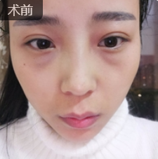 去眼袋手术
