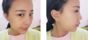 去眼袋手术