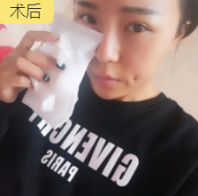 去眼袋手术
