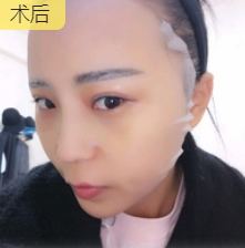 去眼袋手术