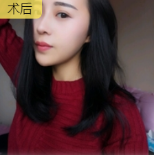 去眼袋手术