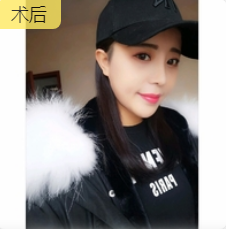 去眼袋手术