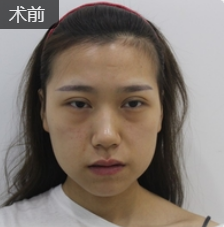 去眼袋手术