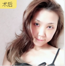 去眼袋手术