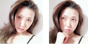 去眼袋手术