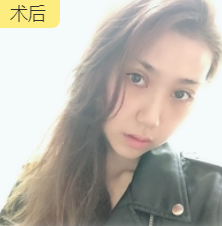 去眼袋手术