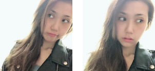 去眼袋手术