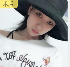 去眼袋手术