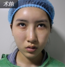 去眼袋手术
