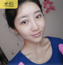 去眼袋手术