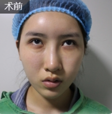 去眼袋手术