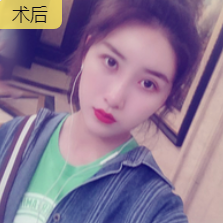 去眼袋手术