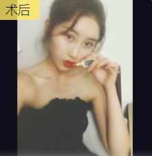 去眼袋手术