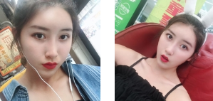 去眼袋手术