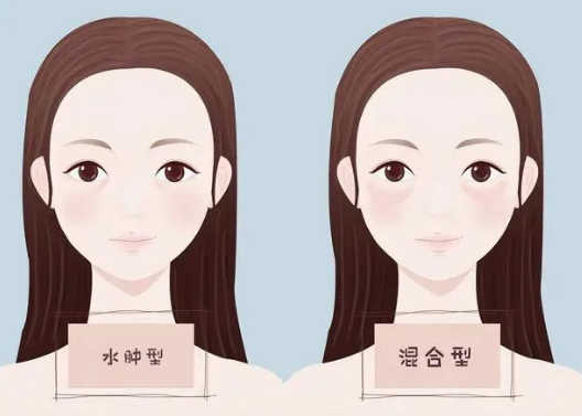 去眼袋手术