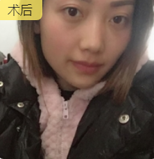 去眼袋手术