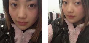 去眼袋手术