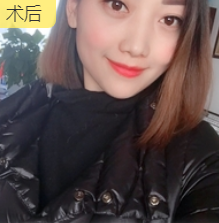 去眼袋手术
