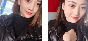 去眼袋手术